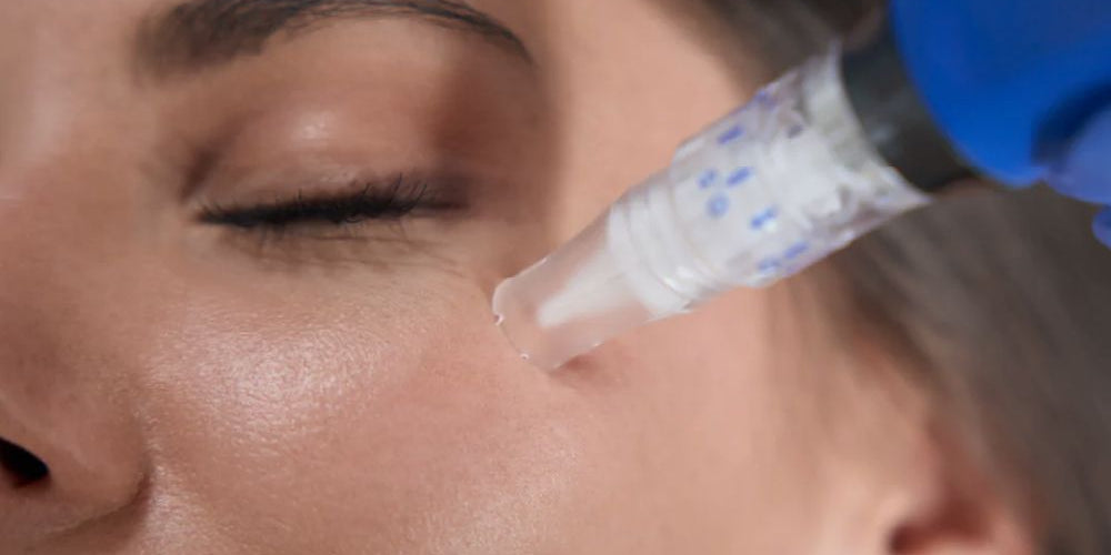 Why microneedling didn’t work