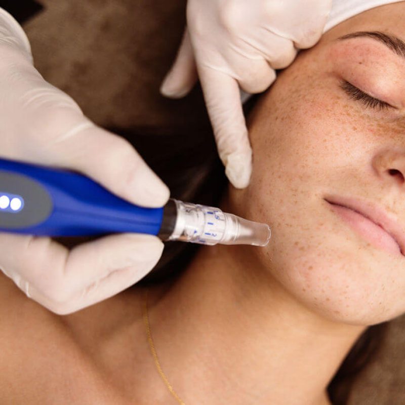skinpen microneedling örebro