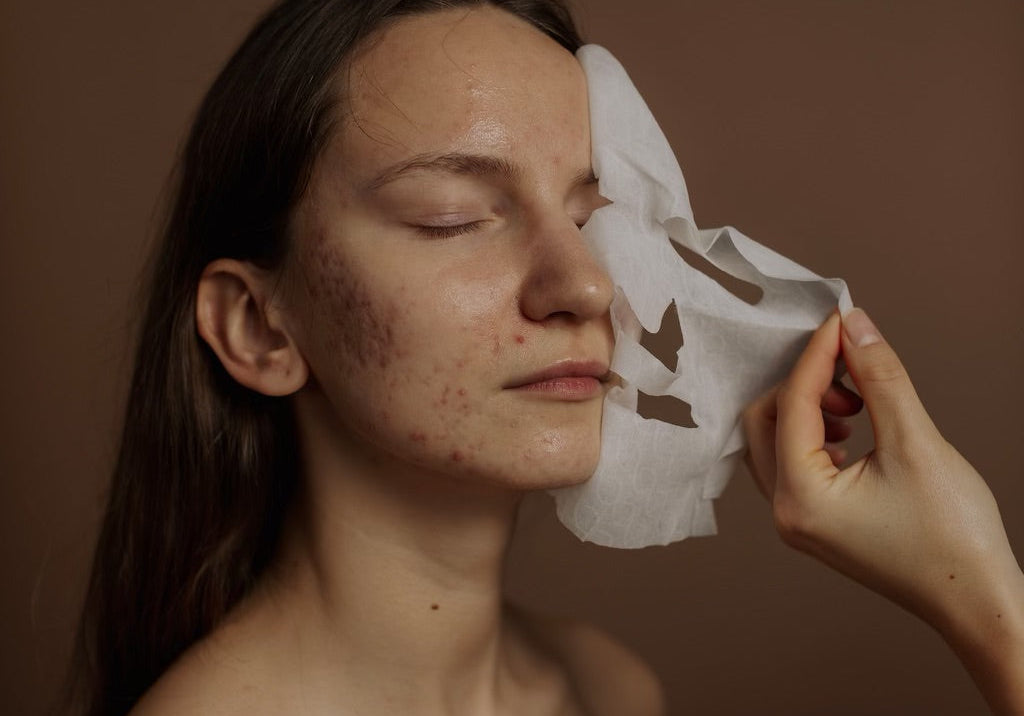 Microneedling during summer