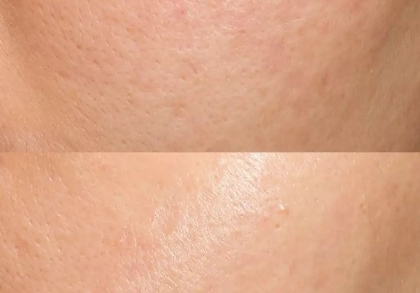 Vivace RF Microneedling Före och Eftervård