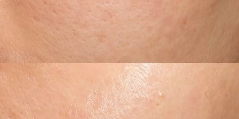 RF Microneedling Före och Eftervård