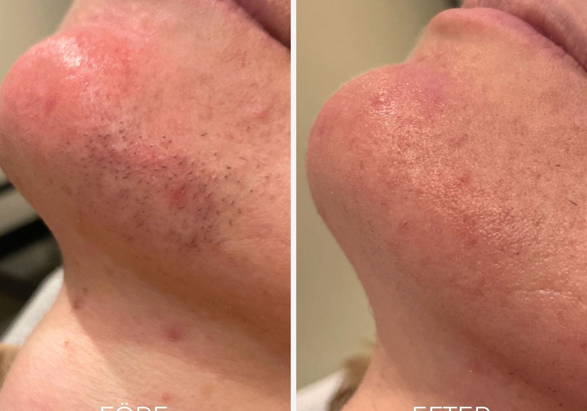 Laser Facial Hair Removal Örebro