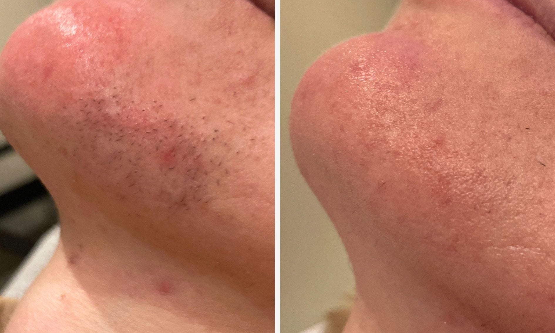 Laser Facial Hair Removal Örebro