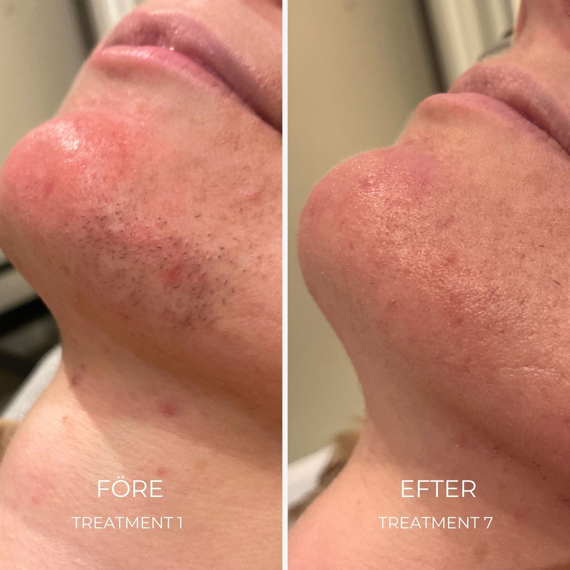 Laser Facial Hair Removal Örebro