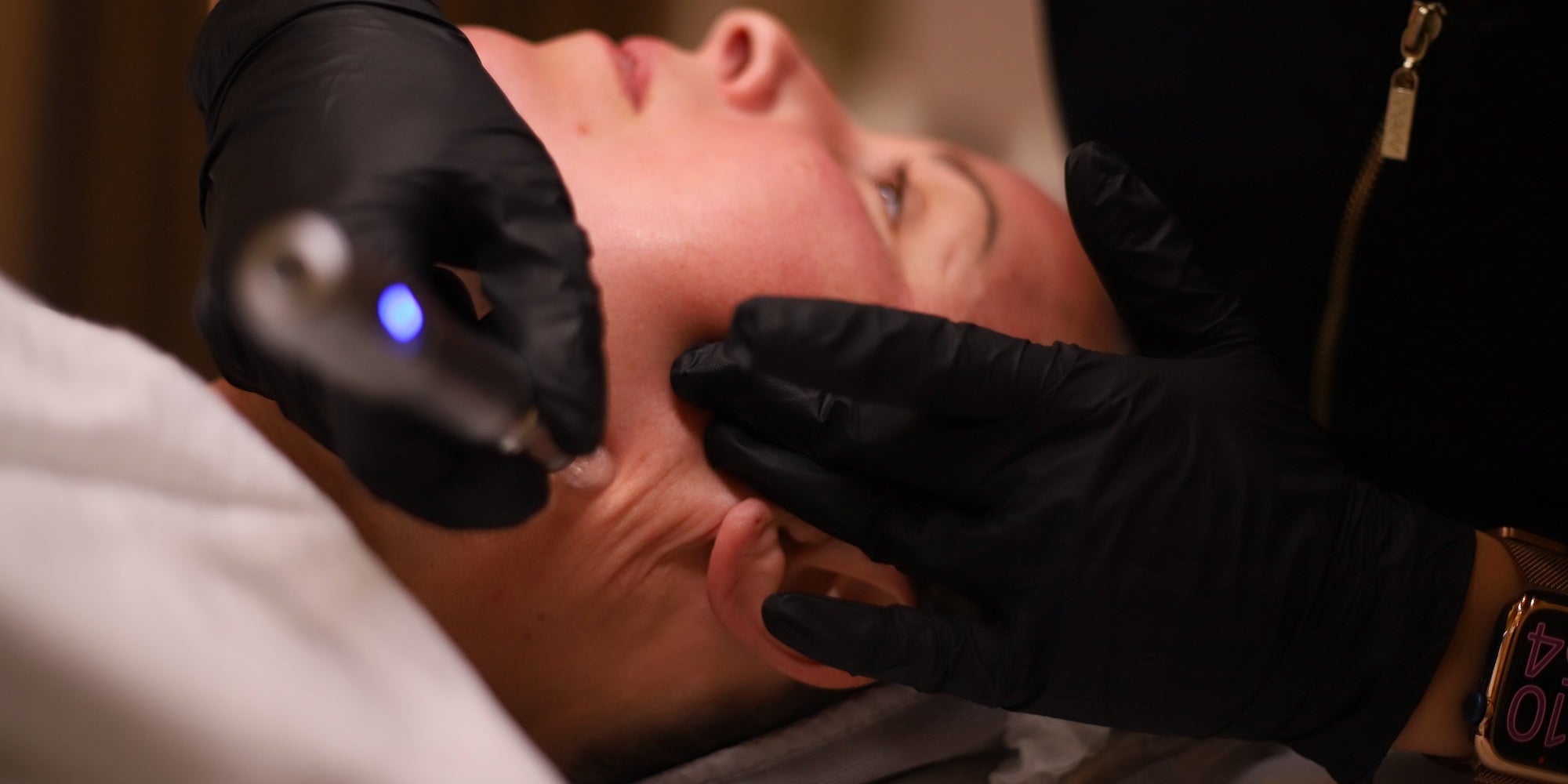 microneedling derma pen örebro bare solutions