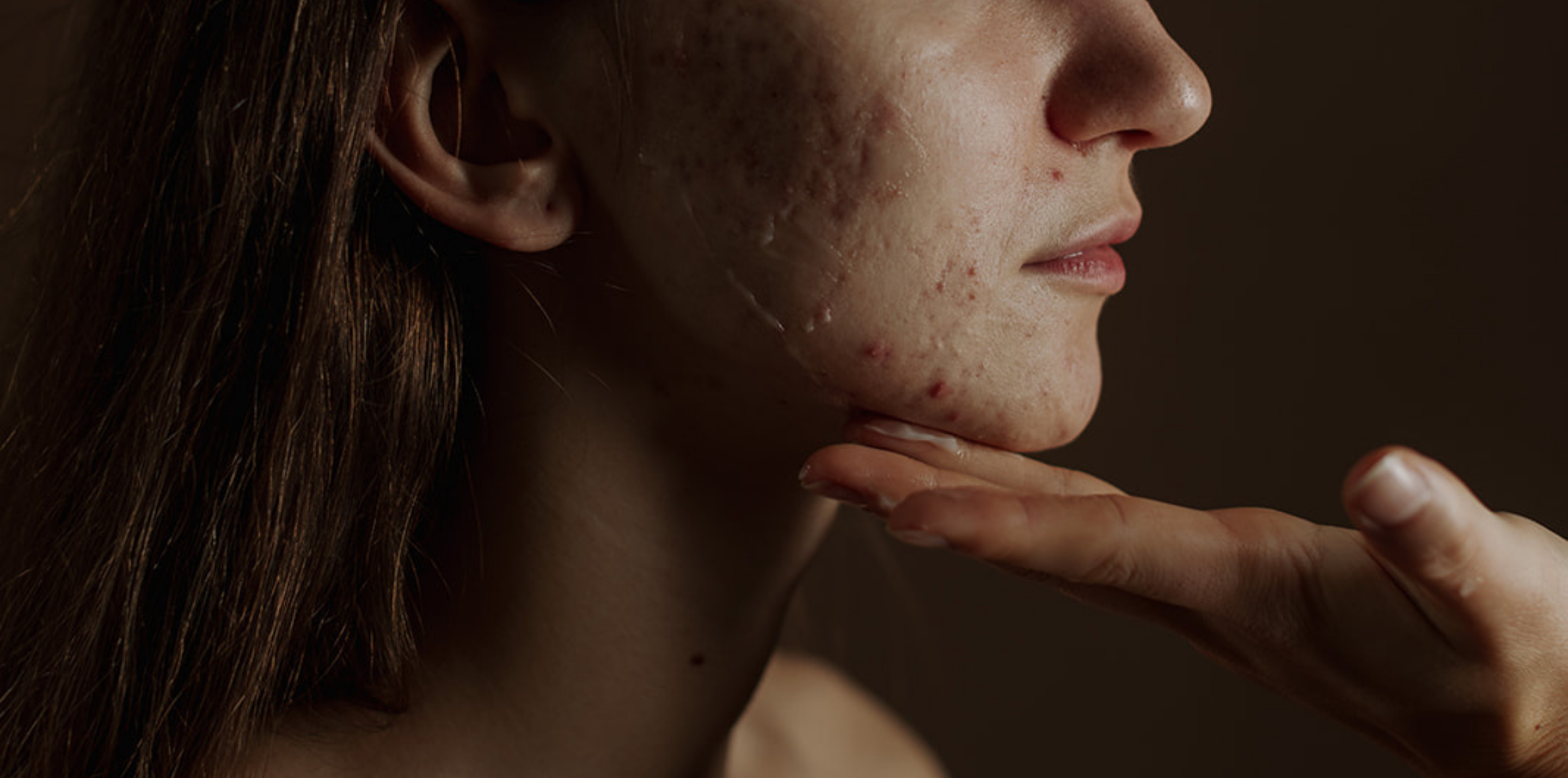 RF Microneedling – Before and Aftercare