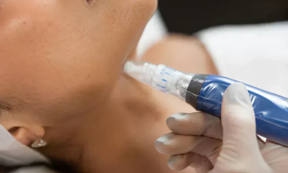 Microneedling: How It Works Beneath the Surface