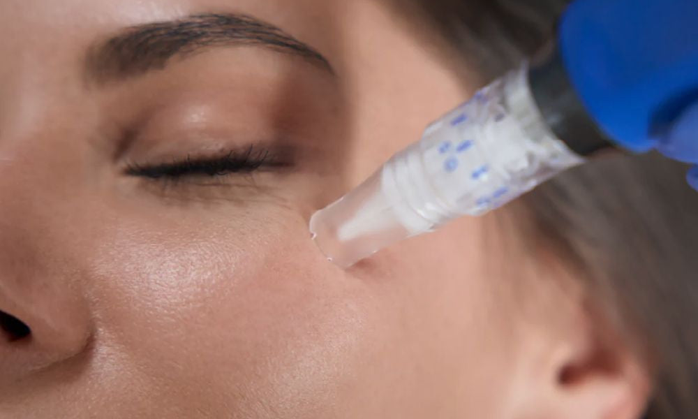 Why microneedling didn’t work
