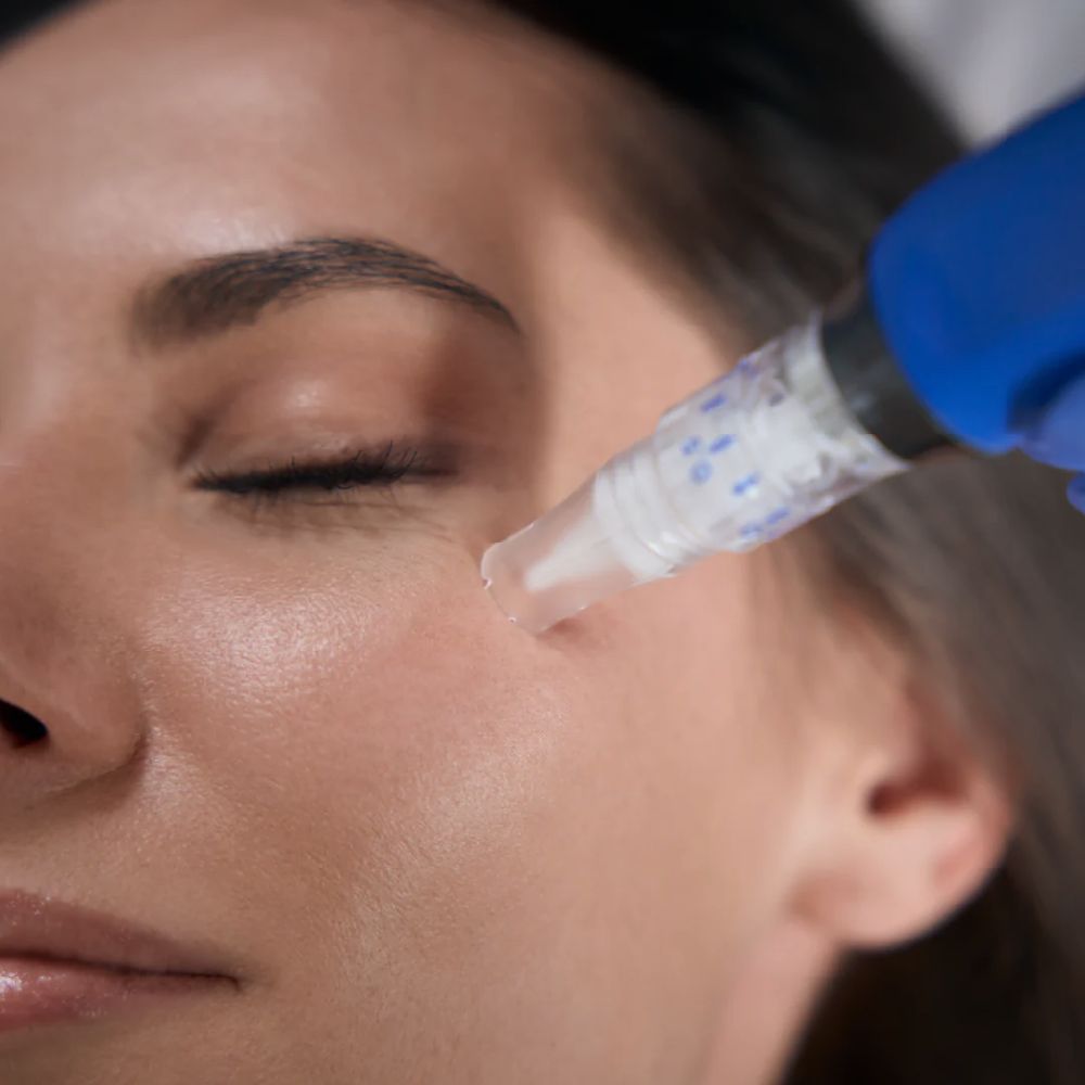 Why microneedling didn’t work