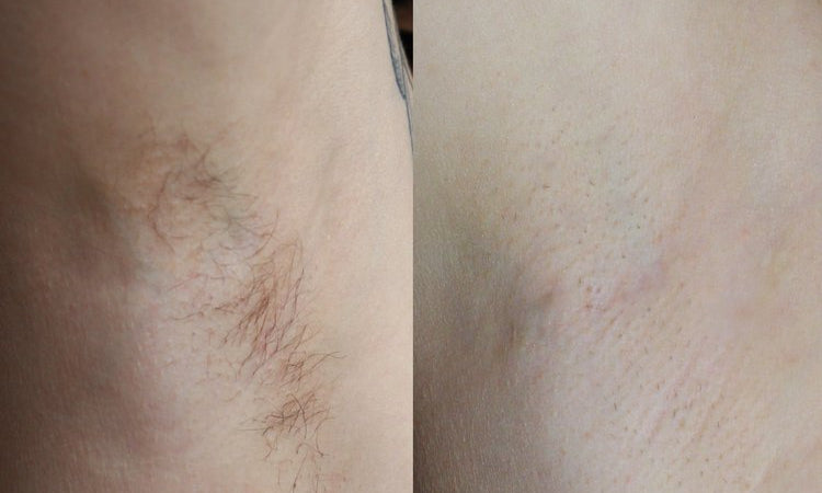 Laser Hair Removal Review - Ida K