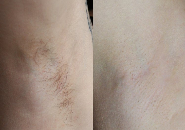 Laser Hair Removal Review - Ida K
