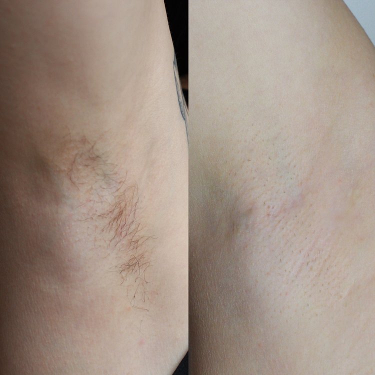Laser Hair Removal Review - Ida K