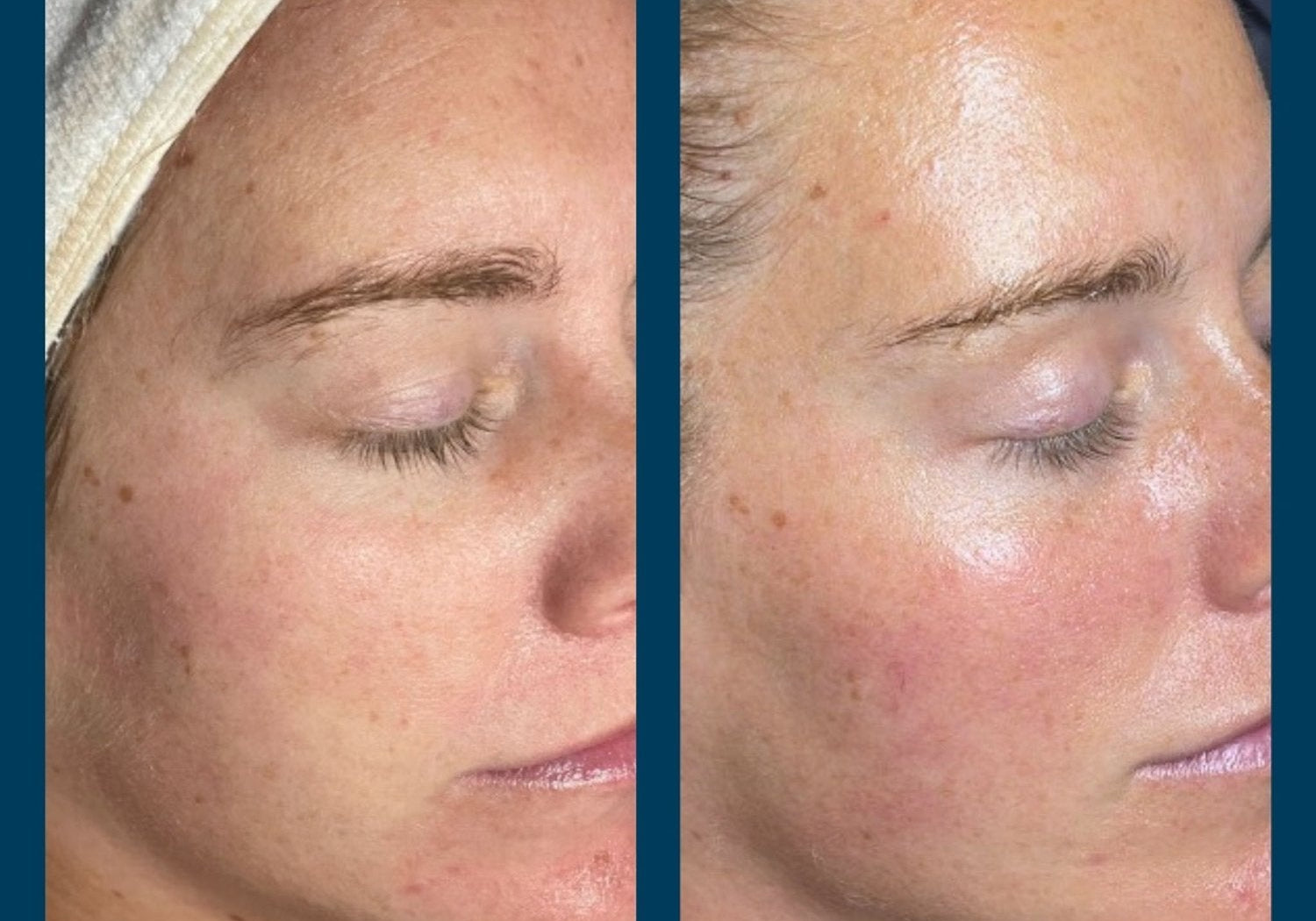 First Time Trying SkinPen Microneedling? Here’s What You Need to Know
