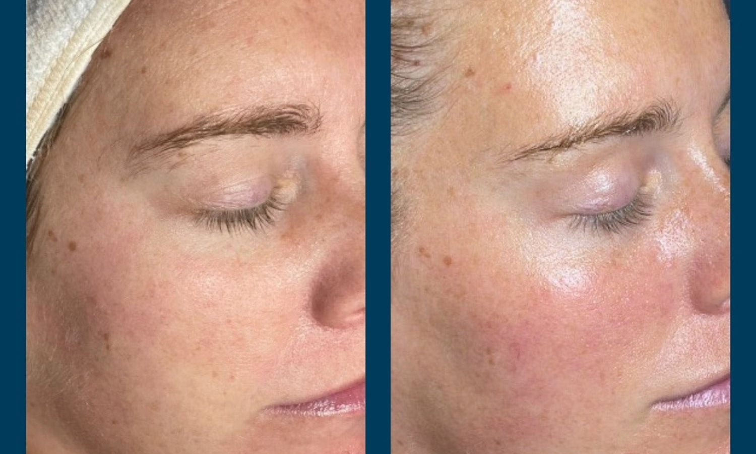 First Time Trying SkinPen Microneedling? Here’s What You Need to Know