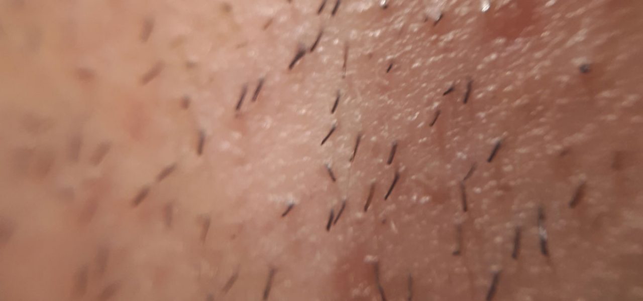 Ingrown Hairs