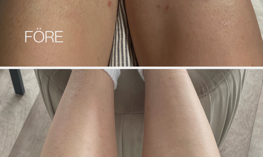 Hair Removal Review - Laser