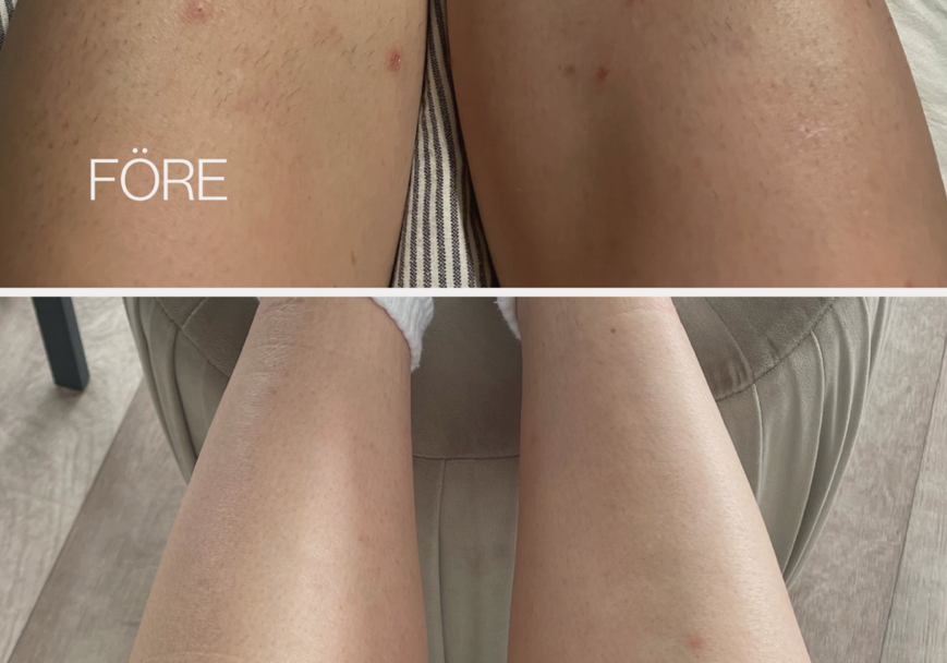 Hair Removal Review - Laser