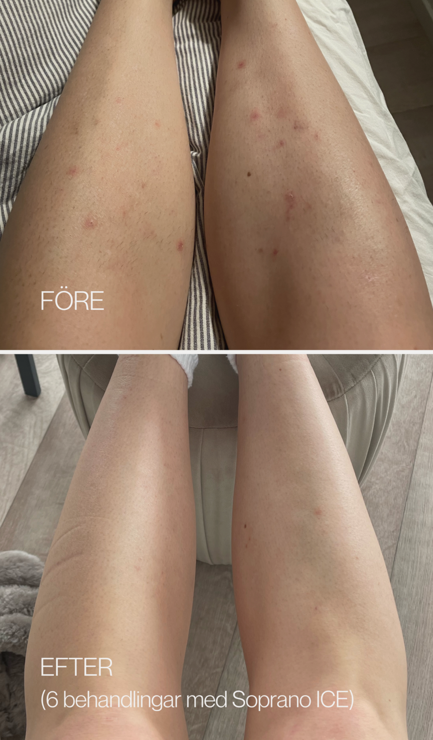 Hair Removal Review - Laser