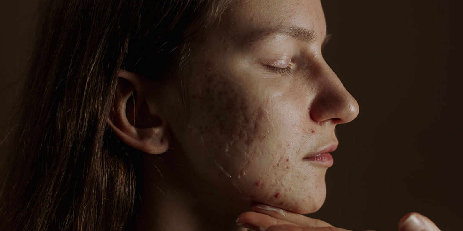 Close-up of a person's face with acne on a dark background