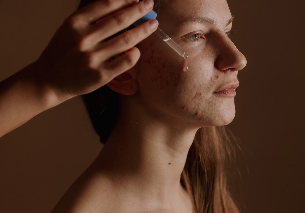 Bare Solutions Acne Örebro