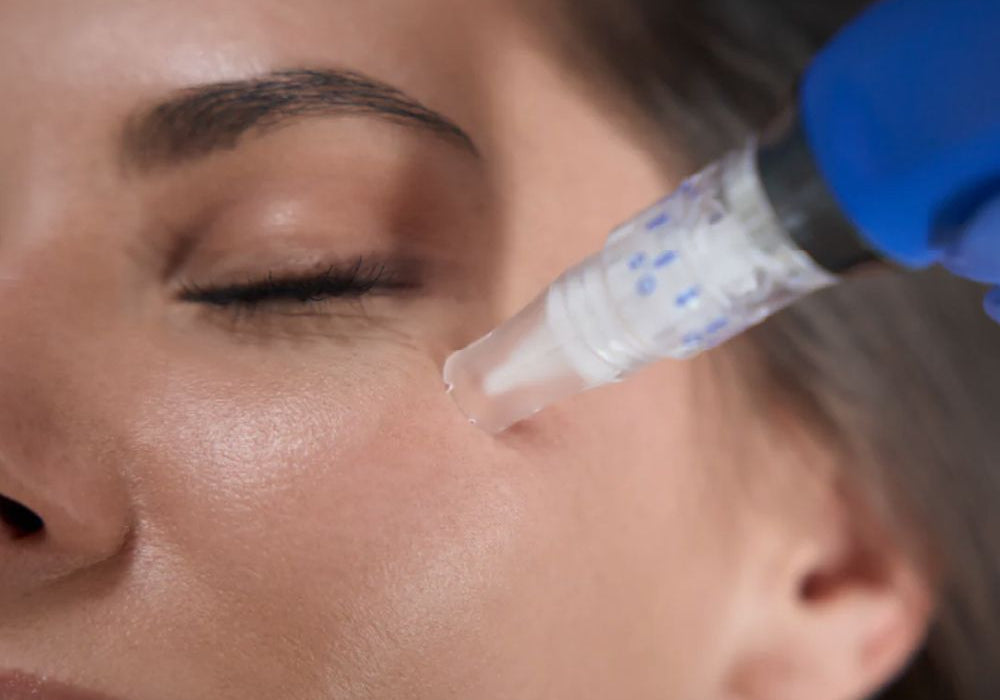 SkinPen Microneedling Örebro