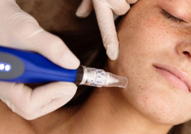 skinpen microneedling örebro